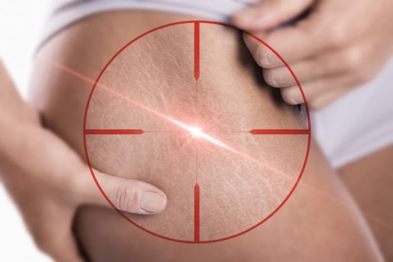 How To Find The Best Laser Fat Removal Procedures In 2022 AskAlbert